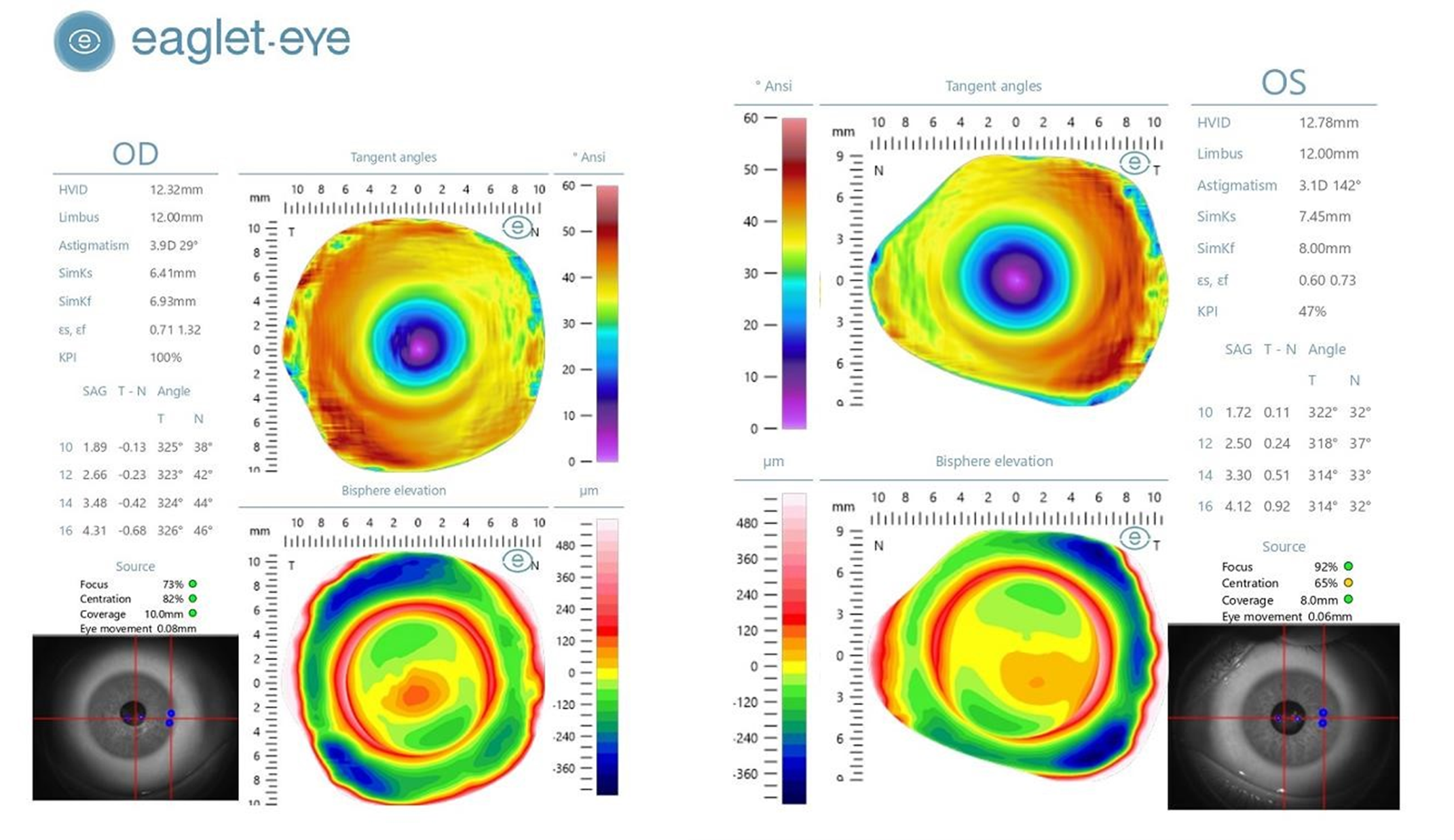 Eaglet Eye ESP — corneo-scleral topography map