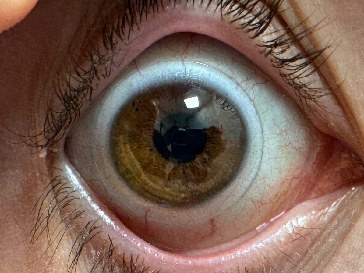 EyePal Mini Scleral lens on eye — FDA approved scleral lens for keratoconus