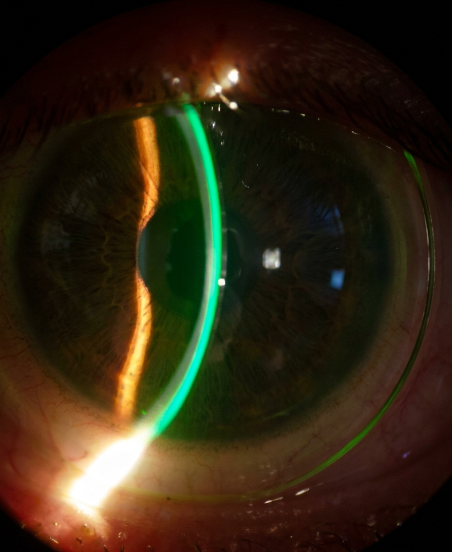 EyePal scleral lens — slit lamp view